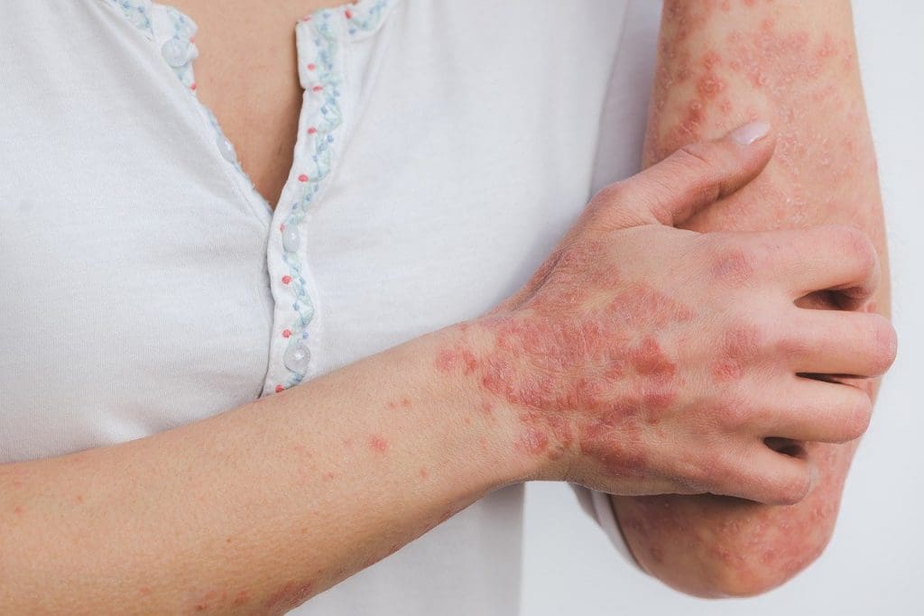 Psoriasis on arm and hand