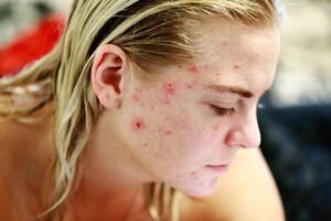 Read more about the article Common Skin Problems and How to Deal with Them