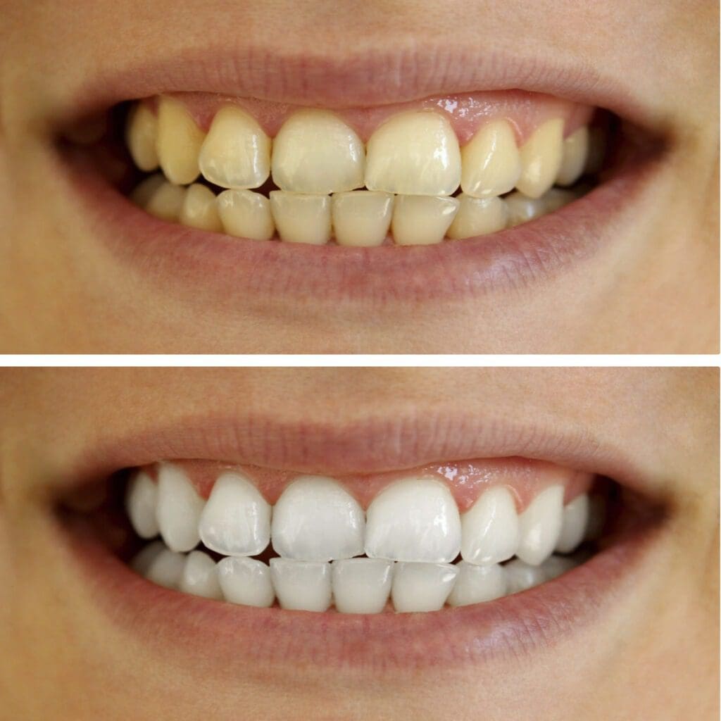 Teeth Whitening 