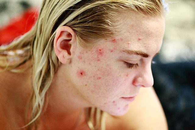 You are currently viewing How to Help Your Teenagers Through a Bad Acne Phase