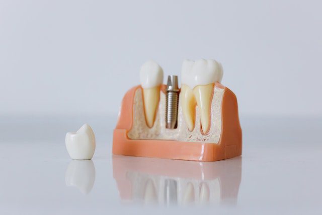 You are currently viewing Dental Implants for Replacing Missing Teeth
