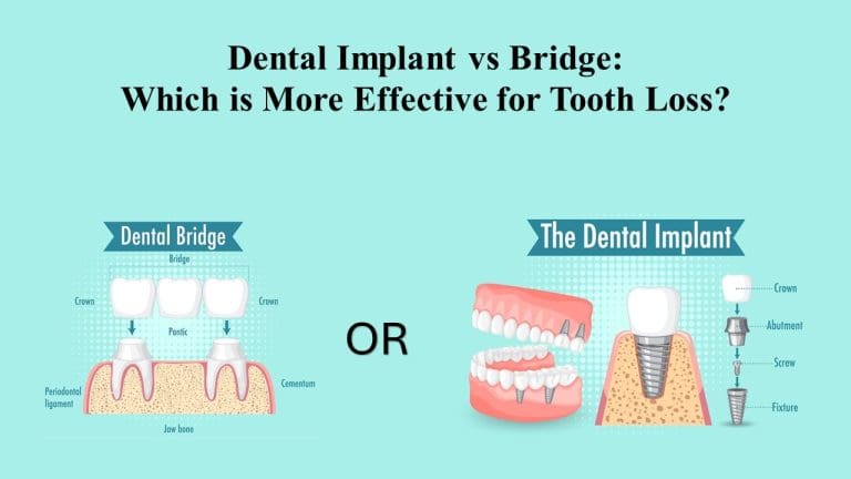 Dental Implant vs Bridge: Which is More Effective for Tooth Loss?