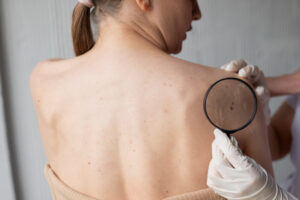 Read more about the article How To Detect Skin Cancer Early: The Role of Regular Skin Checks