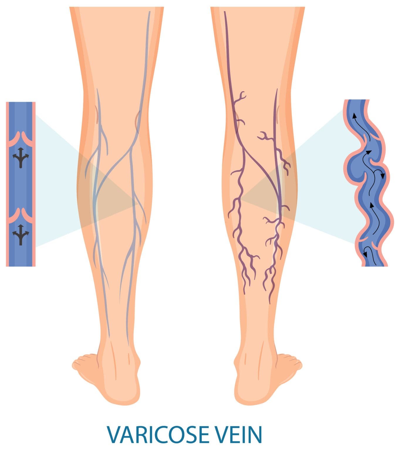 The Effects of Varicose Veins and How to Manage Them - LifeYourWay